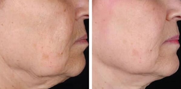 before and after 3 photo laser skin rejuvenation