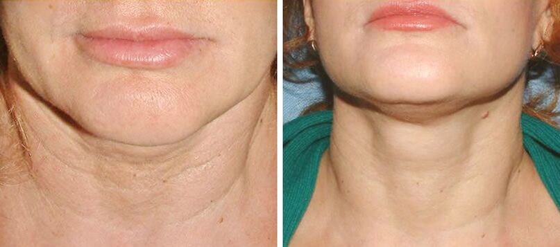 before and after photo laser skin rejuvenation 2