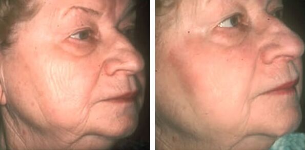 before and after photo laser skin rejuvenation 4