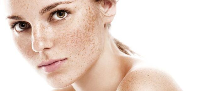 Freckles as a sign of fractional rejuvenation