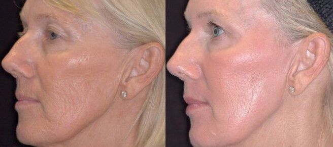 before and after 3 photo segmental skin rejuvenation