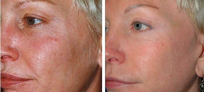 before and after 4 photo segmental skin rejuvenation