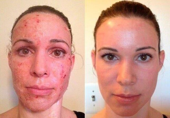 before and after photo segmental skin rejuvenation 1