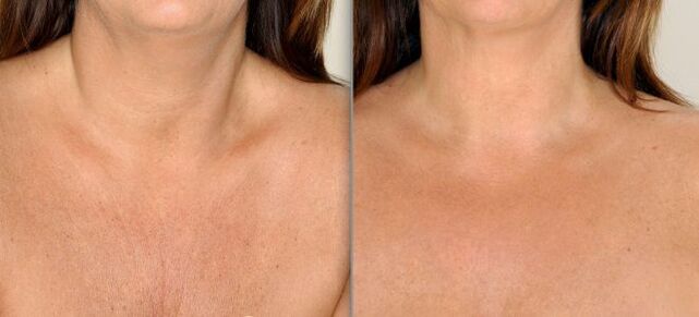 before and after photo segmental skin rejuvenation 2