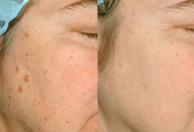 Remove pigments on the skin